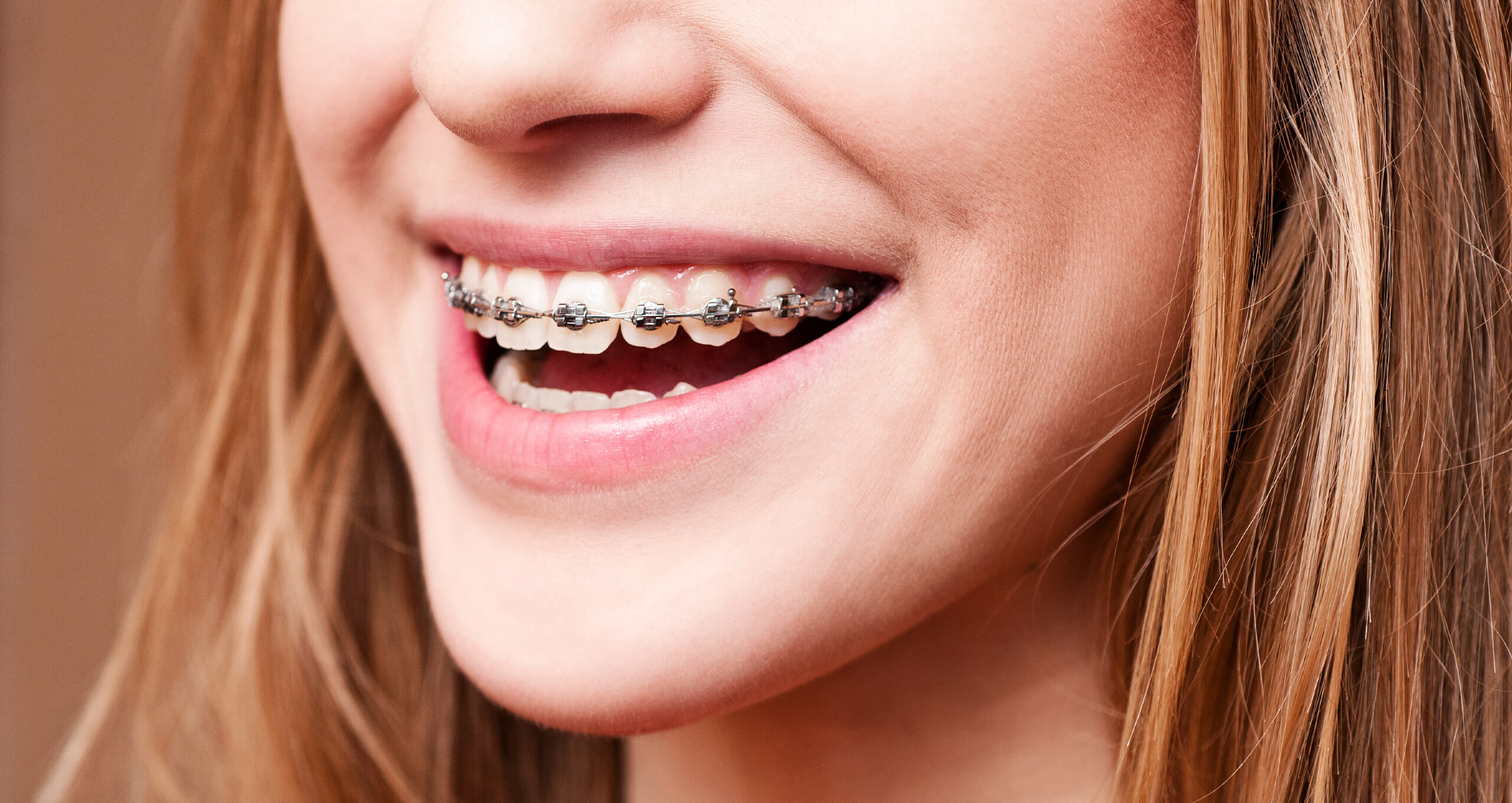 a woman smiling with adult braces