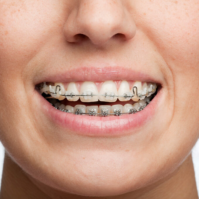 adult braces at loughborough orthodontics