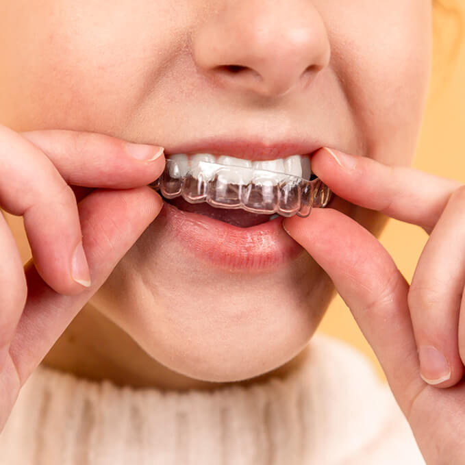 a woman placing one half of her Invisalign braces in her mouth