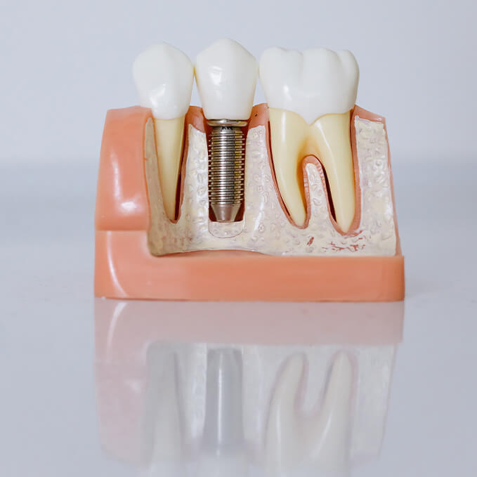 A display of teeth lined up in a row one of which being a dental implant