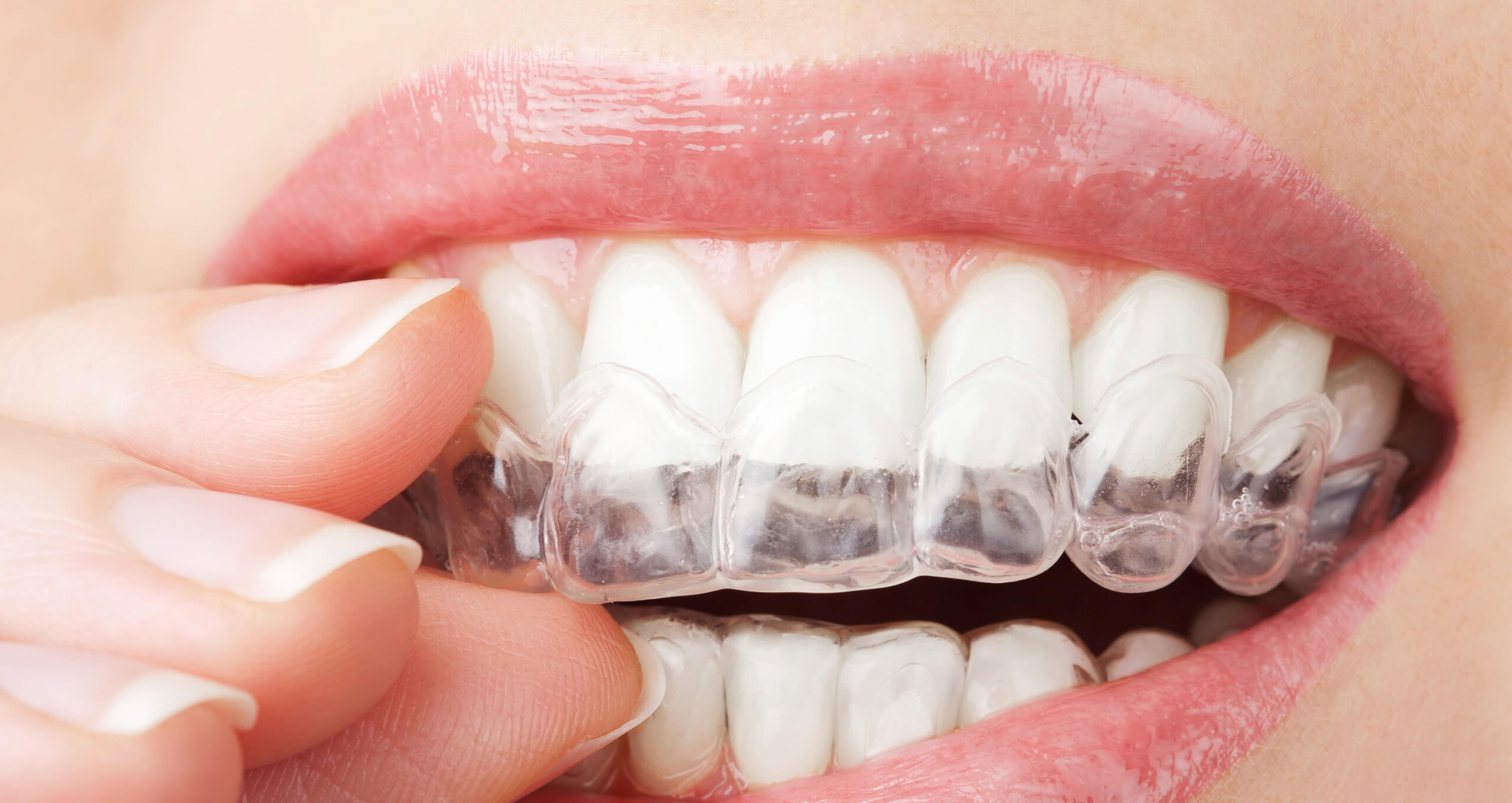 Invisalign Clear Braces at loughborough