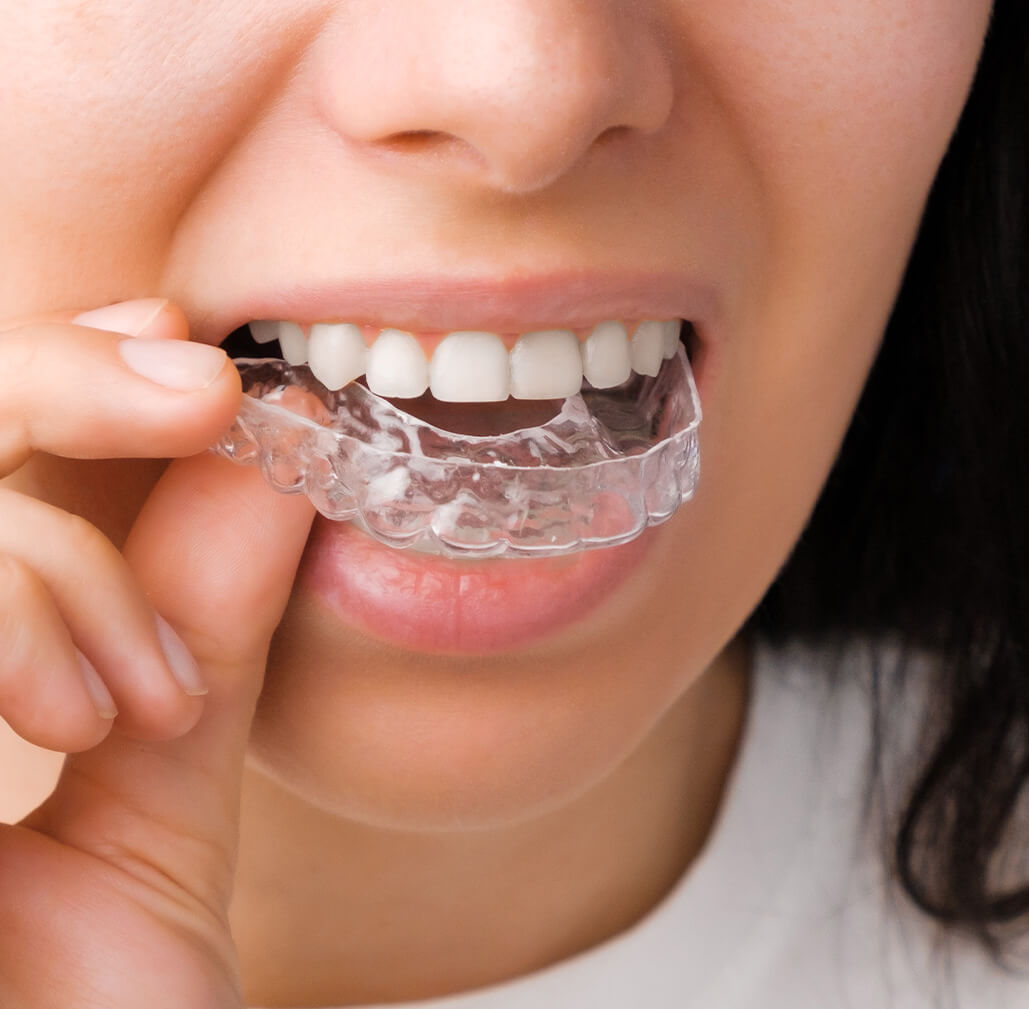 Retainers Loughborough Adults Braces 