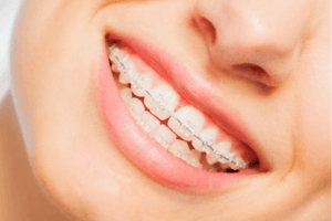 a person smiling with braces on